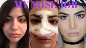 جراحی زیبایی دماغ (رینوپلاستی) چگونه انجام می شود؟