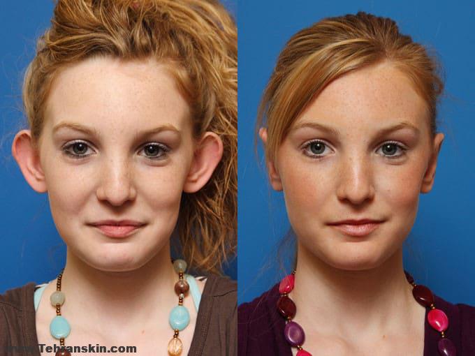 عمل زیبایی گوش در تهران | تغییر شکل گوش |بهترین مرکز جراحی زیبایی گوش