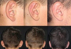 مصاحبه با متخصص جراحی در باره جراحی زیبایی گوش یا اتوپلاستی |مزایای اتوپلاستی