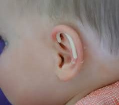 درمان گوش های بیرون زده بدون جراحی