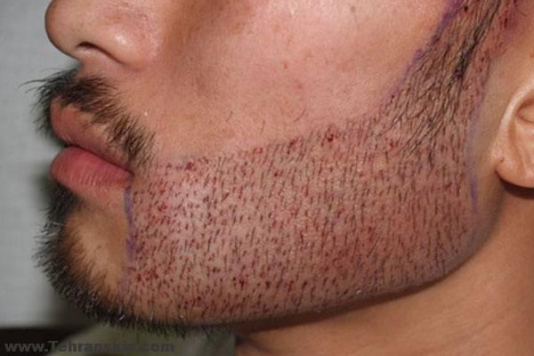 9 تا نکته در باره کاشت ریش که باید بدانید! کاشت مو | بهترین مرکز کاشت مو