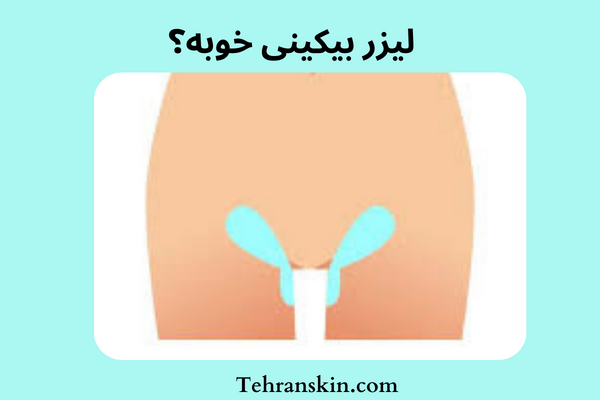 لیزر بیکینی درد داره؟