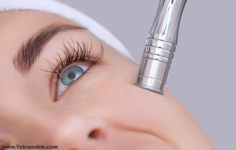 پاکسازی پوست با میکرودرم