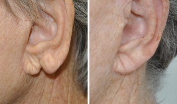 جراحی زیبایی برای اصلاح نرمه گوش 