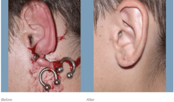 عمل بازسازی نرمه گوش چیست؟ 