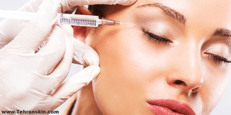 تزریق بوتاکس اطراف چشم