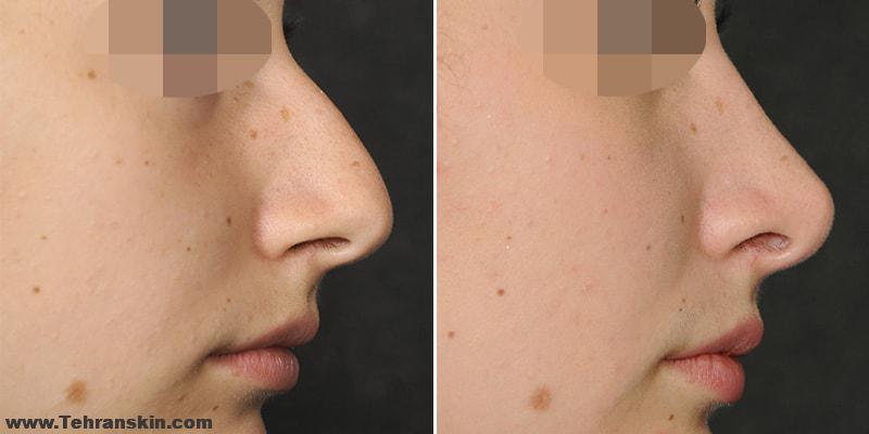 نتیجه بعد از عمل جراحی رینوپلاستی | مزایا ، خطرات و عوارض | مشاوره قبل از عمل