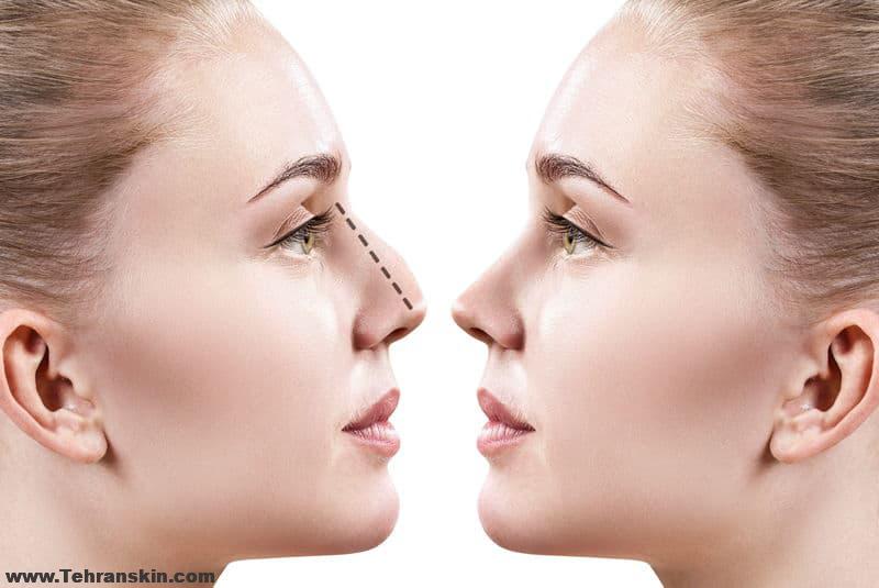 توصیه های من در مورد جراحی زیبایی بینی