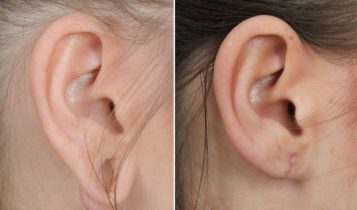 لوبوپلاستی یا عمل جراحی تغییر شکل نرمه گوش