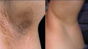 لیزر موهای زائد