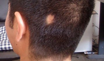 آلوپسی آره آتا Alopecia Areata (AA) 