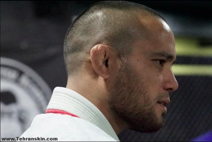 گوش گل کلمی | علل و درمان گوش گل کلمی | جراحی زیبایی گوش گل کلمی