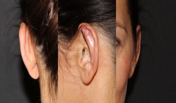جراحی زیبایی گوش با جدید ترین روش | روش جدید اتوپلاستی گوش با ایمپلنت