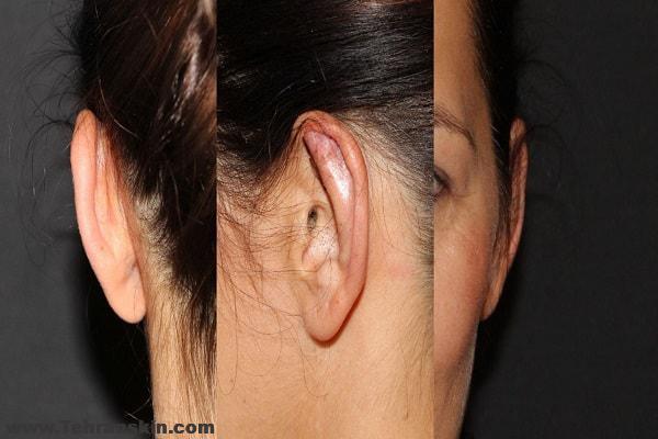 جراحی زیبایی گوش بزرگسالان | روش های جراحی زیبایی گوش توسط بهترین جراح