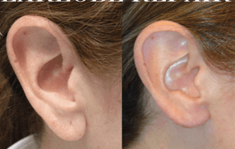 لوبوپلاستی یا عمل جراحی تغییر شکل و کوچک کردن نرمه گوش