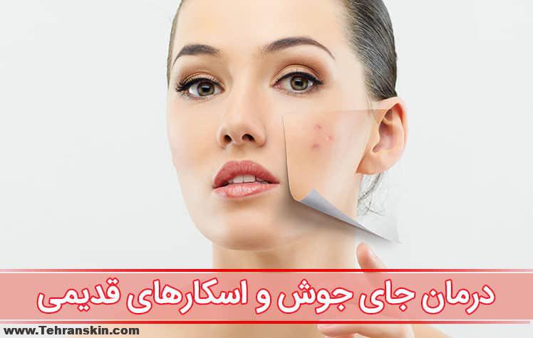 درمان اسکار