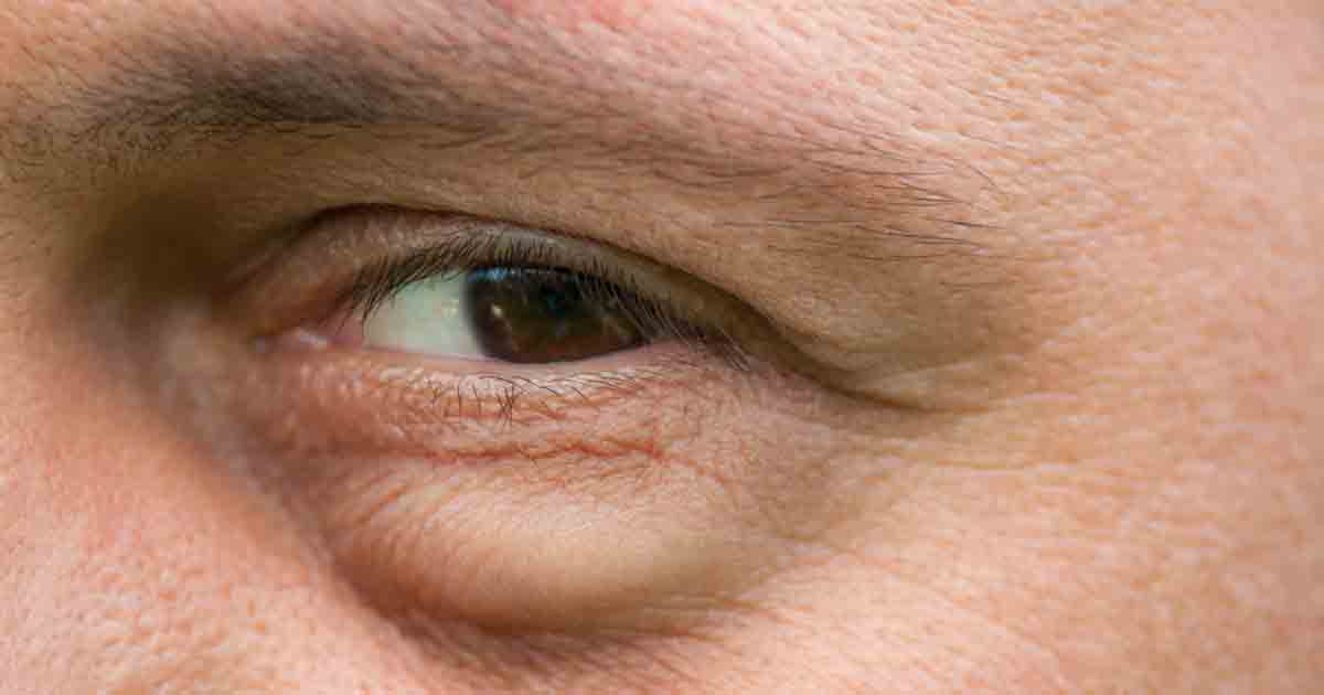 درمان کیسه ی زیر چشم