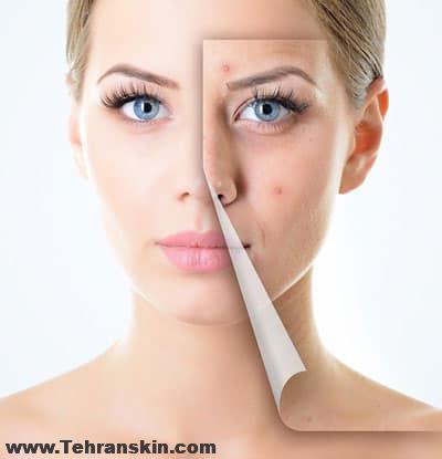 رفع جای جوش یا اسکار