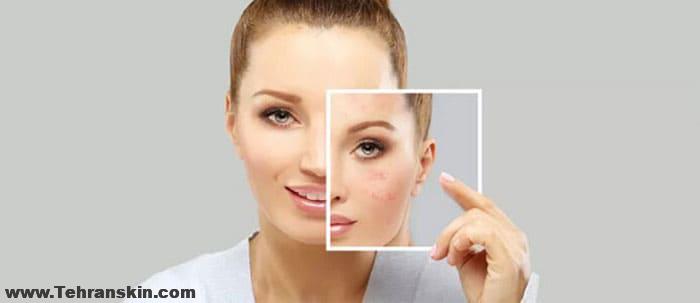 درمان اسکار و جای زخم