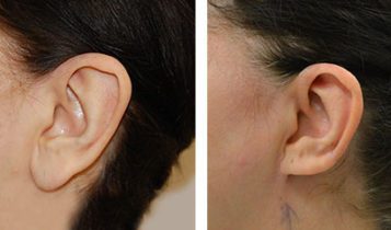 خطرات و عوارض جراحی زیبایی کوچک کردن گوش