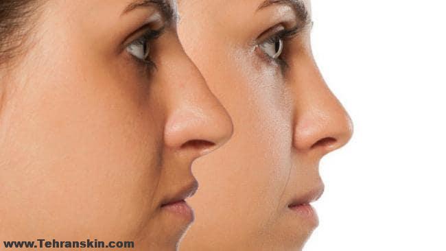 عکس های قبل و بعد رینولاستی | 4 دلیل برای اینکه رینوپلاستی بکنید!