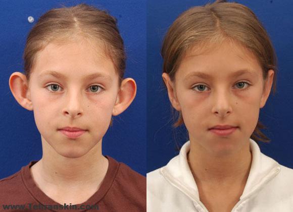 جراحی زیبایی گوش (اتوپلاستی) | اتوپلاستی بدون برش | بهترین دکتر جراحی زیبایی گوش