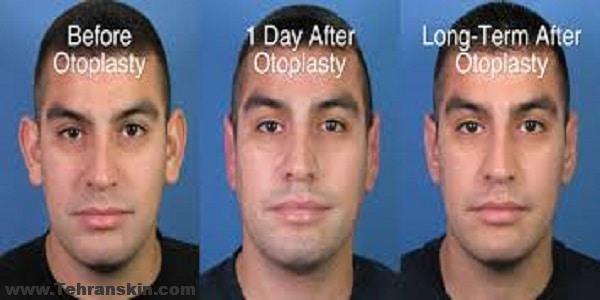 جراحی اصلاحی و زیبایی گوش |چیزهای مهمی که قبل از جراحی اصلاحی گوش باید بدانید