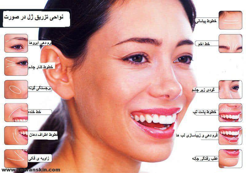 تفاوت بوتاکس و فیلر