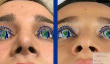جراحی زیبایی بینی با تکنیک بسته یا اندونزال