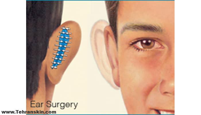 اتوپلاستی برای کوچک کردن گوش های خیلی بزرگ یا ماکروتیا Macrotia