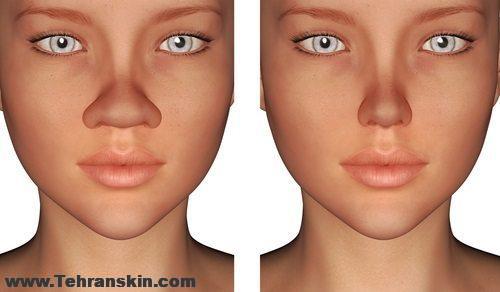 جراحی بینی چگونه انجام می شود؟ | جراحی زیبایی بینی با تکنیک بسته | بهترین جراح رینوپلاستی