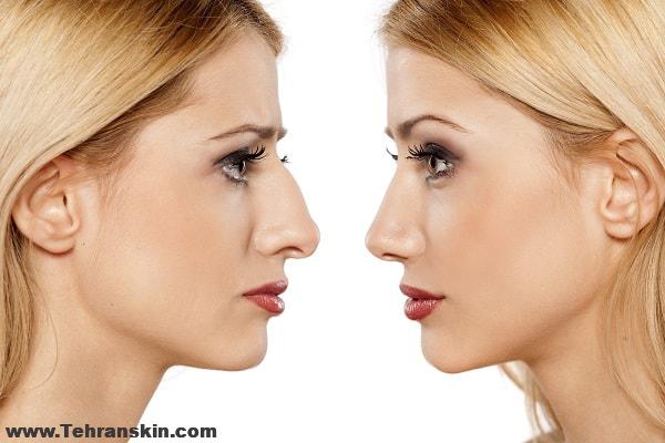 عکس های قبل و بعد رینولاستی | 4 دلیل برای اینکه رینوپلاستی بکنید!