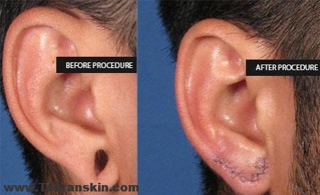 جراحی زیبایی گوش برای بازسازی و اصلاح نرمه و لاله گوش | بهترین مرکز جراحی گوش