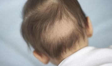  علل غیر دارویی ریزش مو در نوزادان 