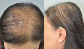 طاسی الگوی زنانه یا الوپسی آندروژنیک | علل ، تشخیص و درمان آن | کاشت مو  