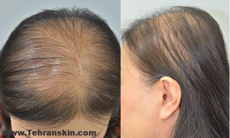 طاسی الگوی زنانه یا الوپسی آندروژنیک | علل ، تشخیص و درمان آن | کاشت مو