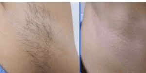 لیزر موهای زائد در دوران شیردهی