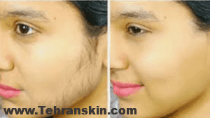 رفع موهای زائد