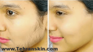 رفع موهای زائد