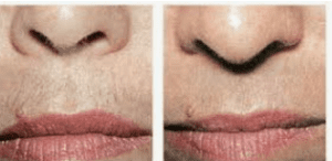 مراقبتهای قبل از لیزر