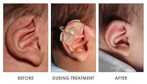 درمان ناهنجاری های گوش