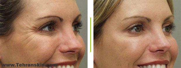 تزریق بوتاکس صورت