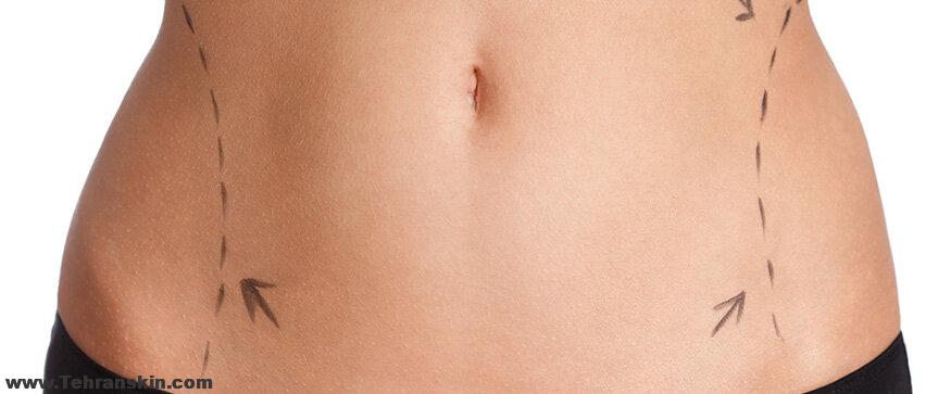 حذف چربی بدون جراحی