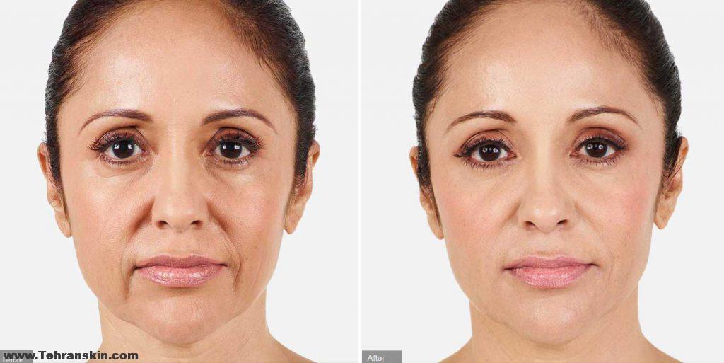 ماندگاری بوتاکس