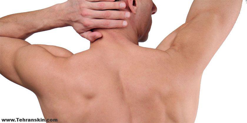 نحوه لیزر موهای زائد کل بدن بدون درد | بهترین مرکز لیزر موهای زائد ، مرکز برکه