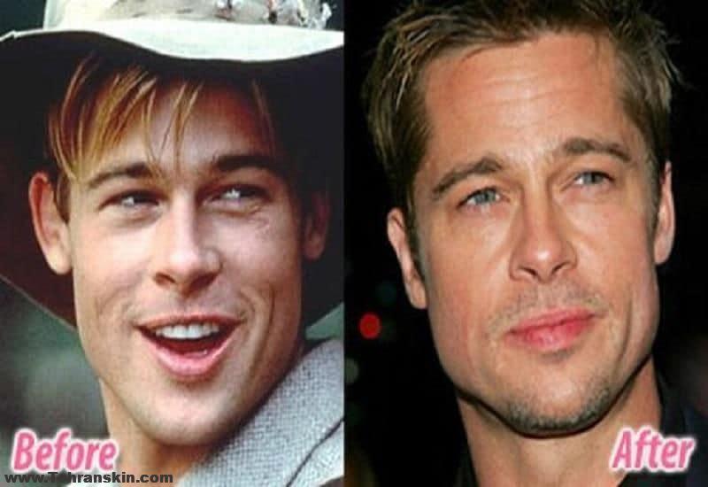 جراحی پلاستیک گوش | جراحی پلاستیک گوش بهترین گزینه برای گوش های میکی موسی