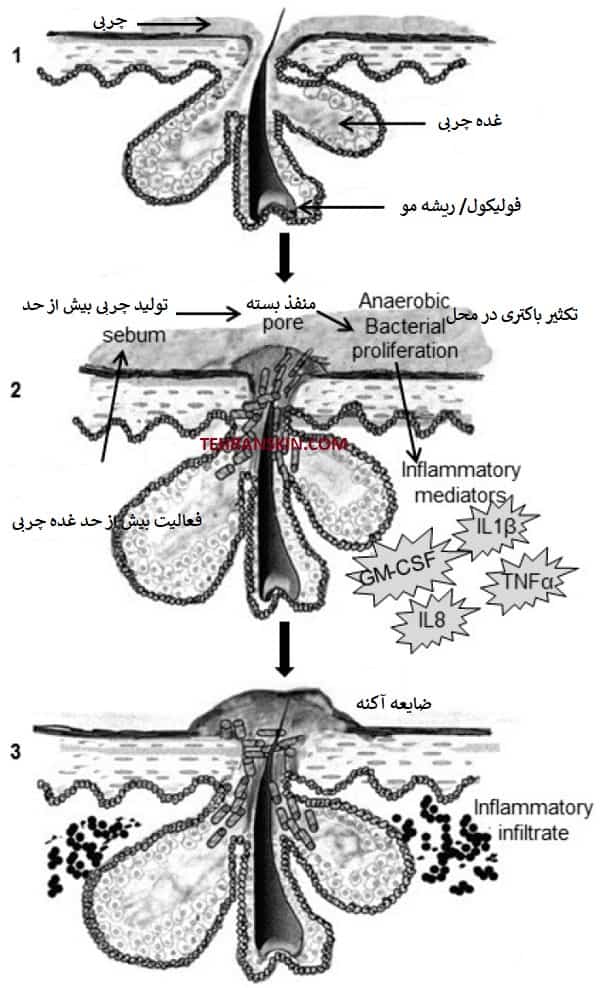 علت جوش و آکنه و درمان جای جوش و آکنه در مرکز برکه