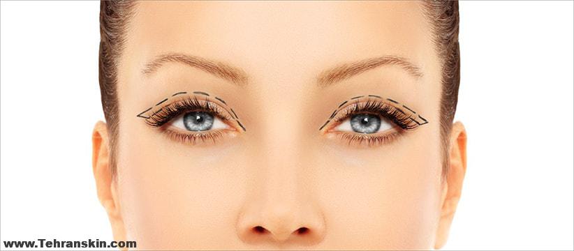 عمل روی پلک