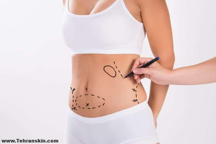 پیکرتراشی و تزریق چربی