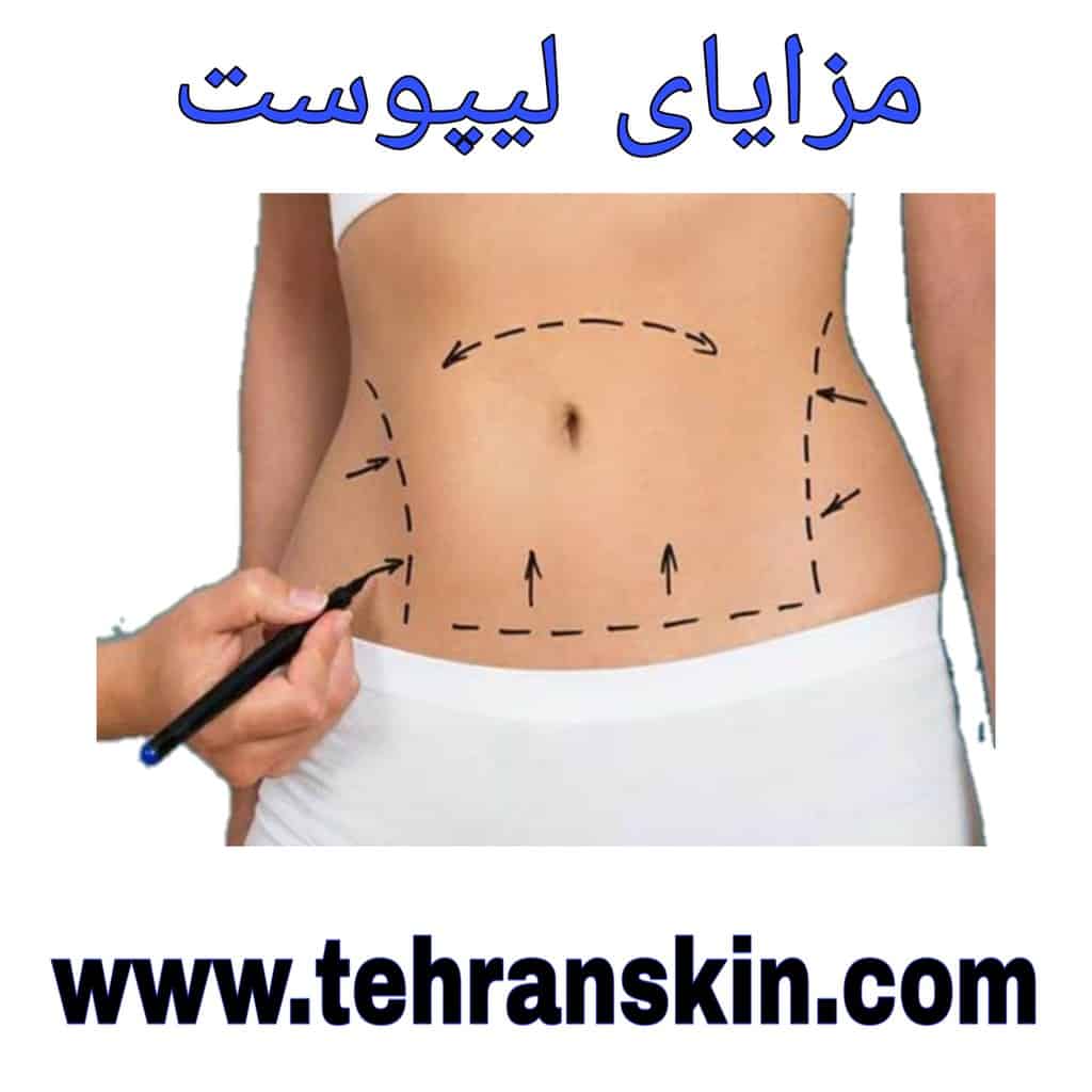 مزایای لیپوست نسبت به مابقی روش های برداشت چربی